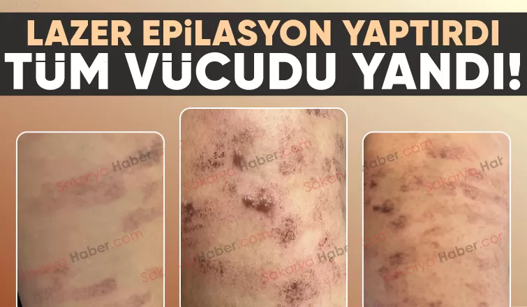 Lazer epilasyonda vücudu yandı