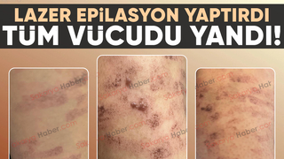 Lazer epilasyonda vücudu yandı