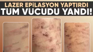 Lazer epilasyonda vücudu yandı