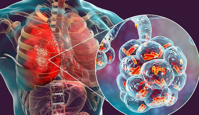 Lejyonella bakterisi 3 kişiyi öldürdü