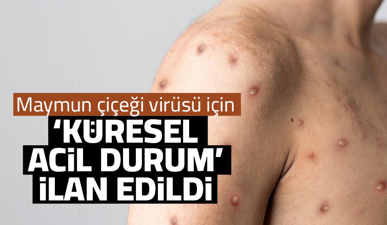 Maymun çiçeği için acil durum