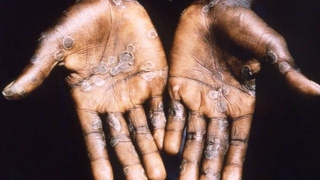 Maymun çiçeği virüsü İsviçre'ye sıçradı