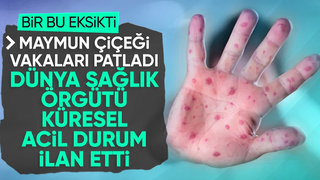 Maymun çiçeği virüsüne karşı dünya çapında acil durum ilan edildi