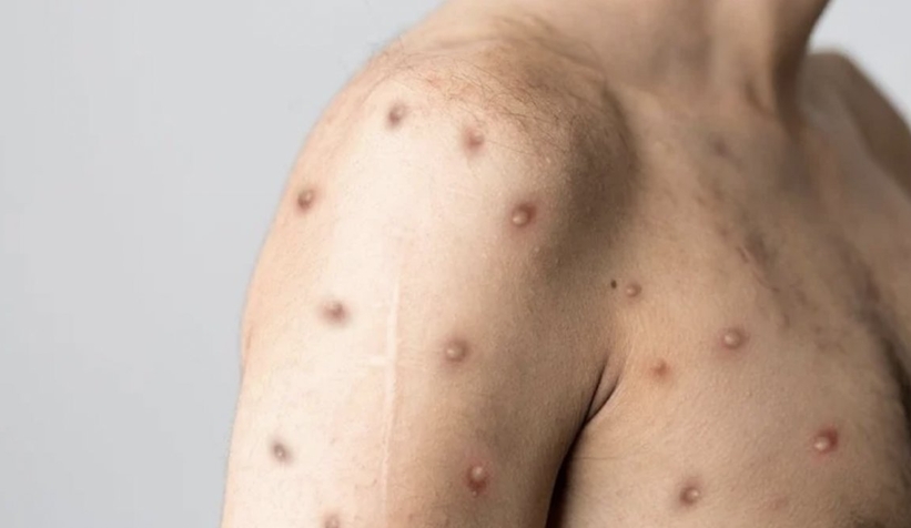 Maymun çiçeği virüsünün ismi değiştiriliyor