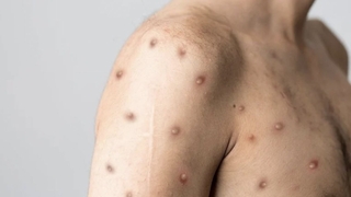 Maymun çiçeği virüsünün ismi değiştiriliyor