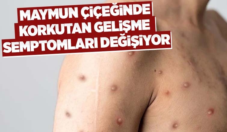 Maymun çiçeğinde semptomlar değişiyor