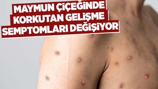 Maymun çiçeğinde semptomlar değişiyor