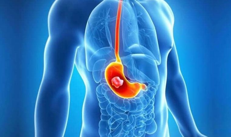 Mide kanseri riskini yüzde 26 düşürüyor