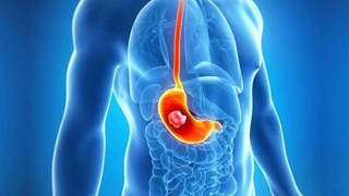 Mide kanseri riskini yüzde 26 düşürüyor