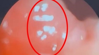 Nefes borusundan ve gözünden sinek larvaları çıktı