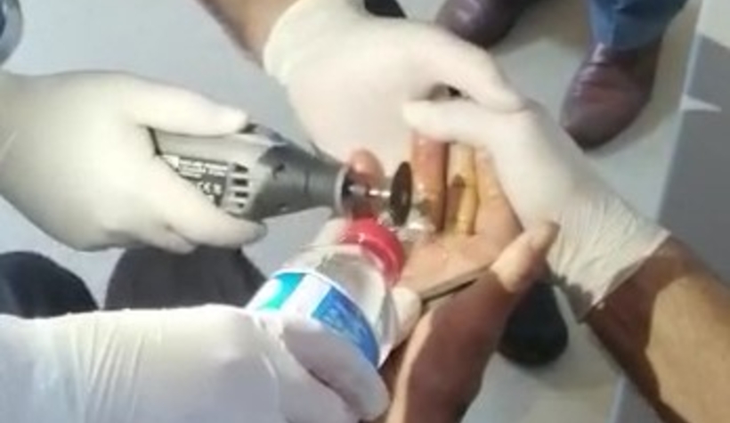 Parmağa sıkışan yüzük kesilerek çıkarıldı