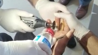 Parmağa sıkışan yüzük kesilerek çıkarıldı