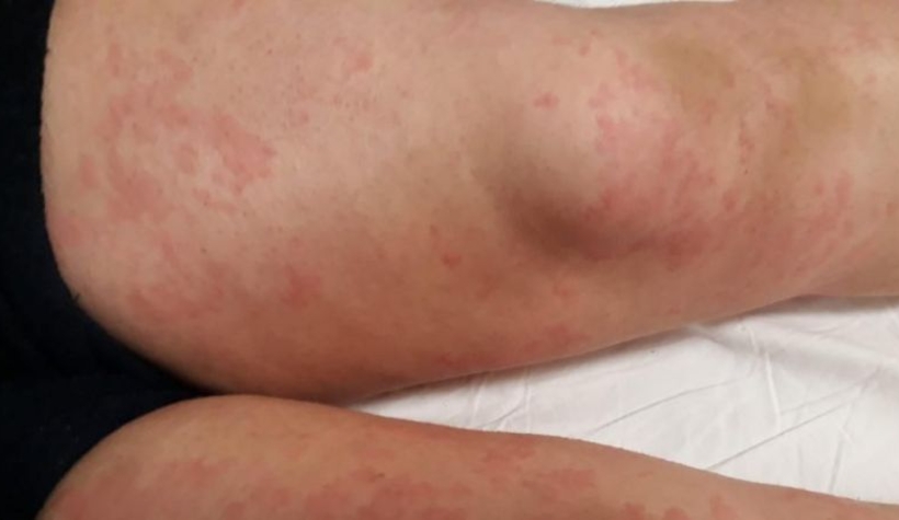 Sakaryalı korona hastası kadın tıp literatürüne girdi