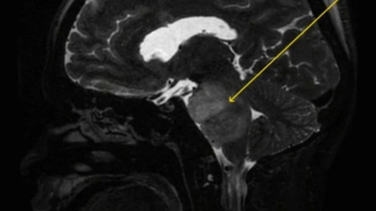 Tam 4 aydır hiç durmadan hıçkırıyor