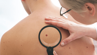 Yeni oluşan benler cilt kanseri belirtisi olabilir'